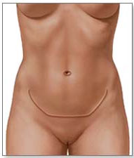 tummy tuck scars abroad